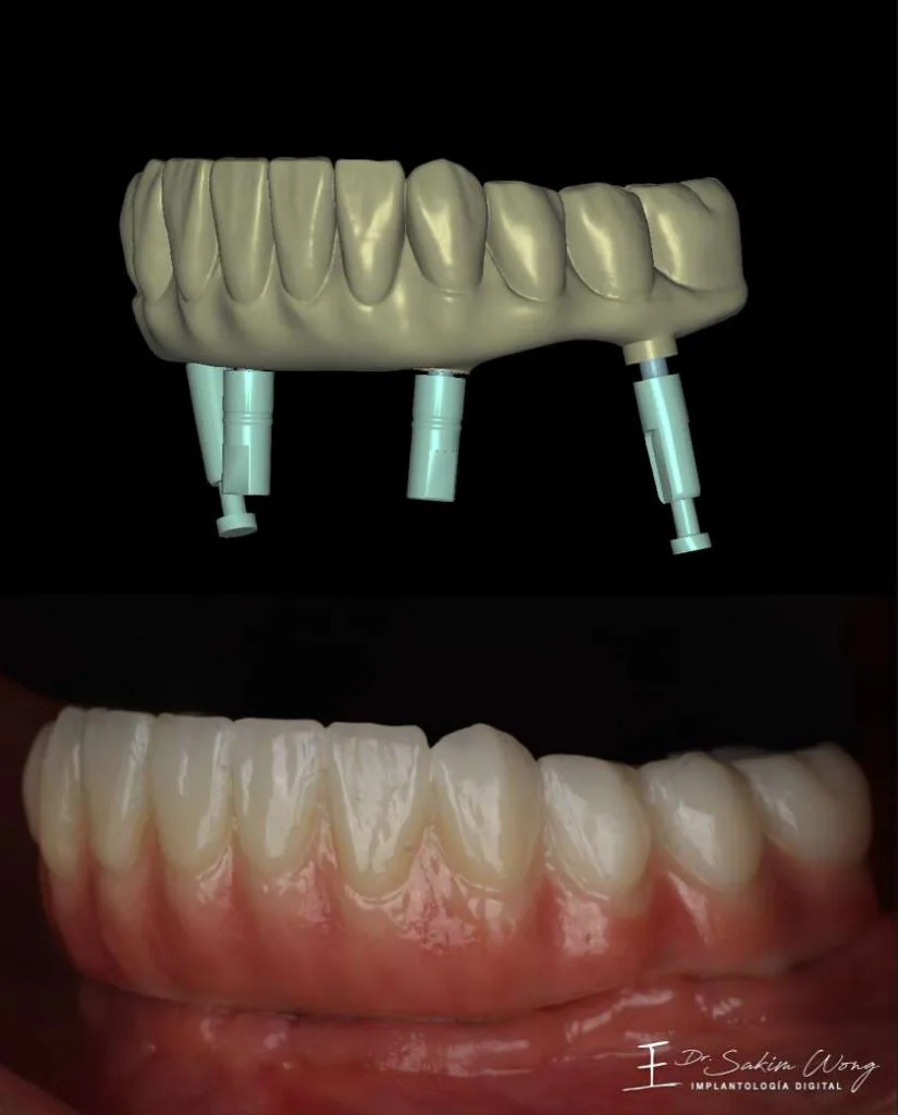 Side view of a full-arch design and clinical result