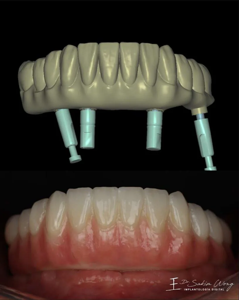 Front view of a full-arch design and clinical result