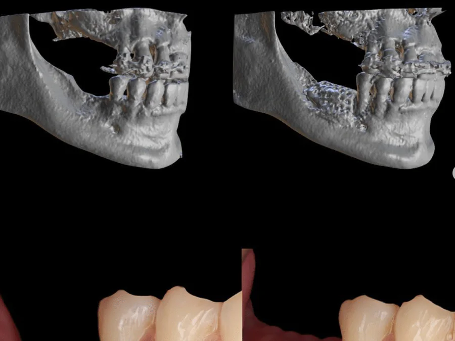 A precise digital plan aligns implant depth, soft tissue stability, and prosthetic positioning.