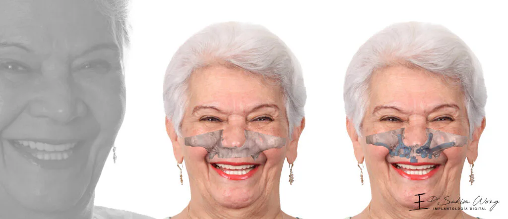 Patient before implant rehabilitation