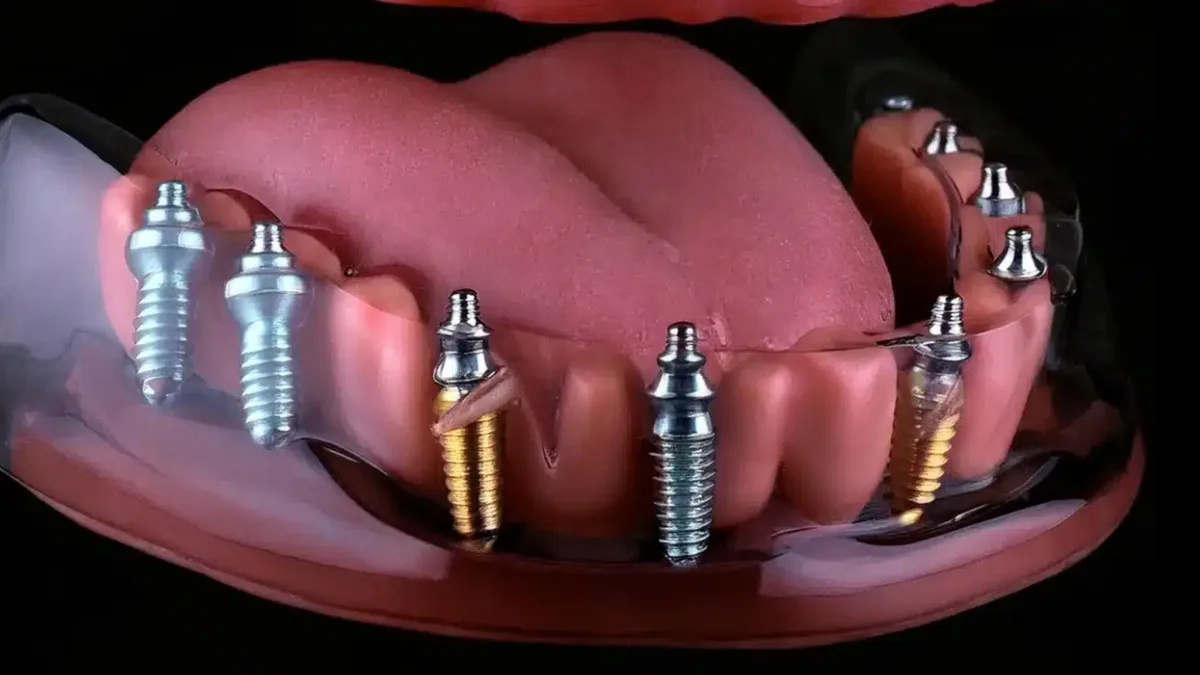 Digital full-arch implant simulation